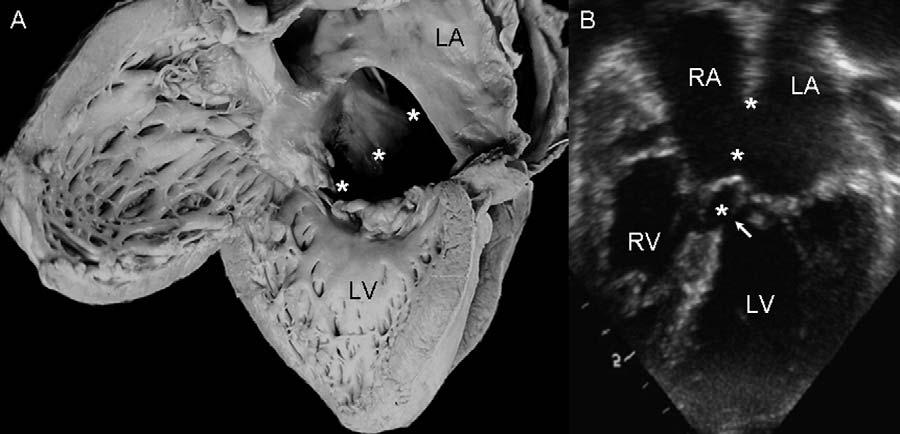 Volume 19 Number 9 Muñóz-Castellanos et al 1187 Figure 6 A, View of left chambers of heart with Rastelli s type A atrioventricular canal.