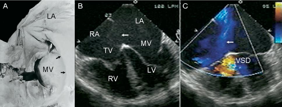 B, Echocardiographic 4-chamber image shows atrio-vsd with its 3 components: ostium primum, atrioventricular defect, and interchordal spaces of VSD (arrow).