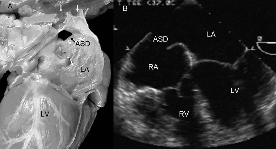 1188 Muñóz-Castellanos et al September 2006 Figure 8 A, Internal view of left atrium (LA) of heart with superior sinus venosus type atrial septal defect (ASD).