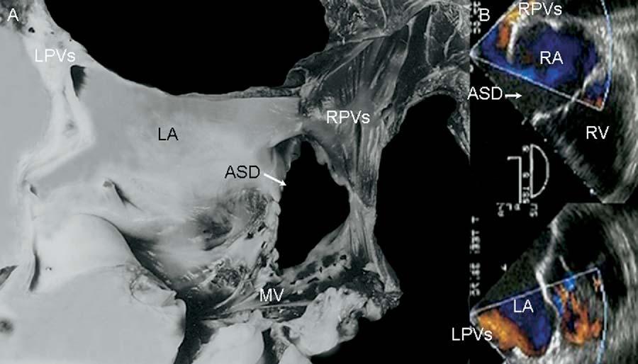 B, Two-dimensional apical 4-chamber image shows superior sinus venosus type ASD that extends from atrial roof. LV, Left ventricle; RA, right atrium; RV, right ventricle.