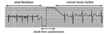 Cardioversion Most elective or non-emergency cardioversions are performed: To treat atrial fibrillation or