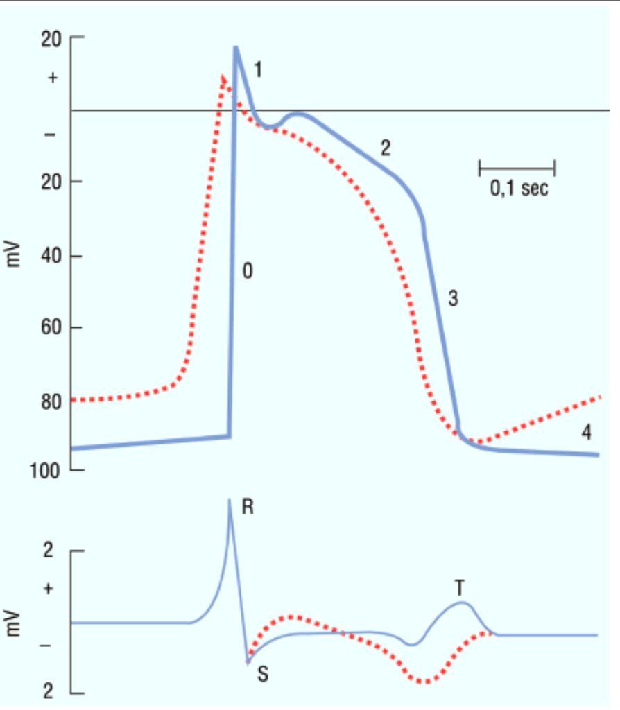 CARDIAC ACTION POTENTIAL (UPPER) AND EGC TRACE (LOWER) MODIFICATIONS UNDER DIGITALIS.