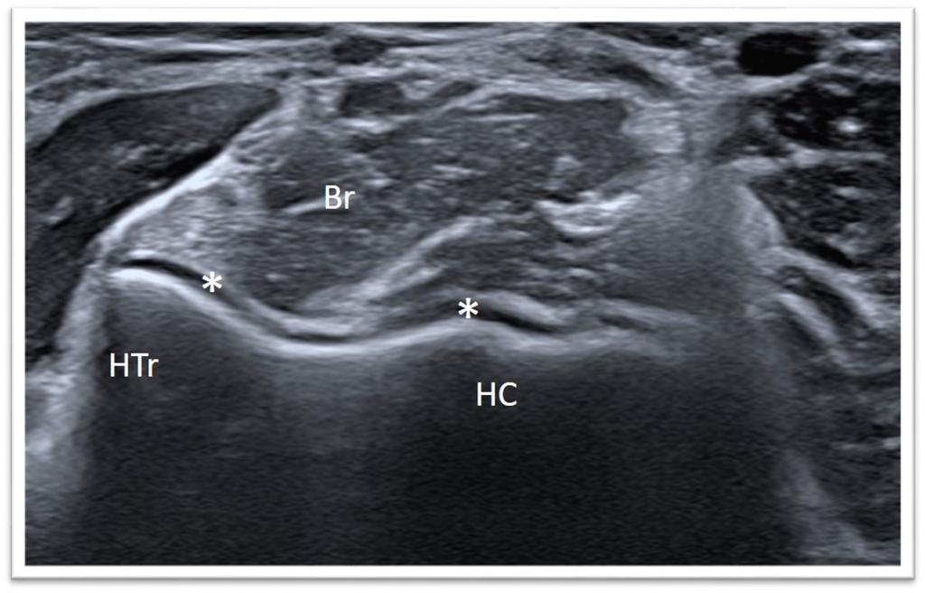 Fig. 3: Br, brachialis muscle; HC, humeral capitellum; HTr, humeral