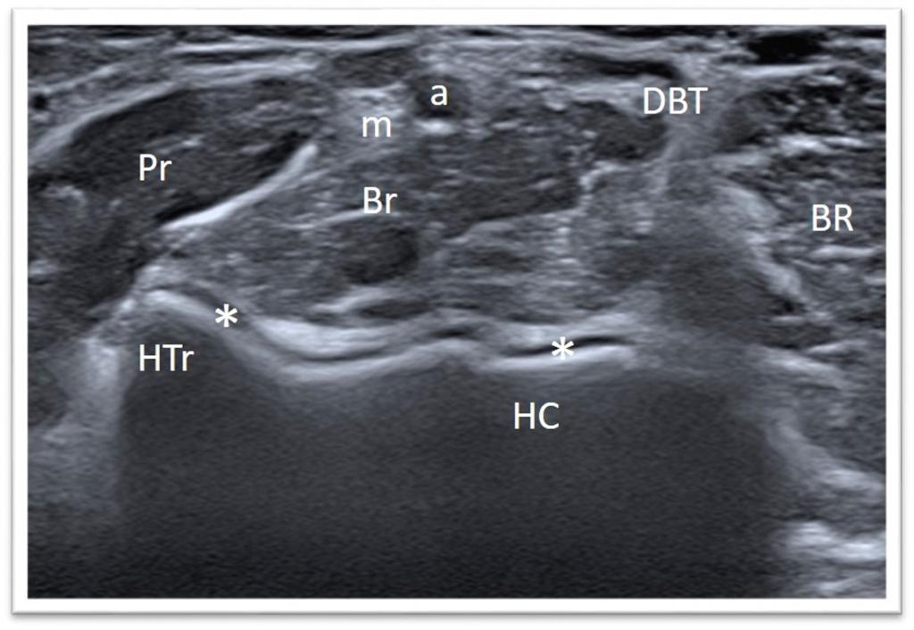 Fig. 5: a, brachial artery; m: median nerve; DBT, distal biceps tendon;