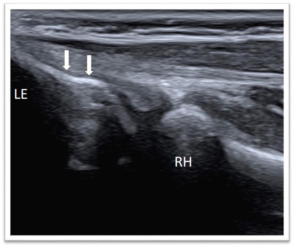 Fig. 9: Arrow, lateral ulnar collateral ligament;