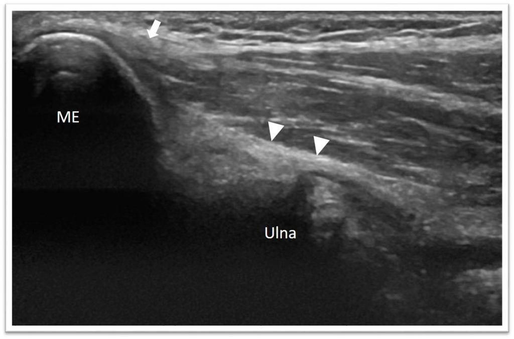 Fig. 14: Arrowheads, anterior bundle of the medial collateral ligament;
