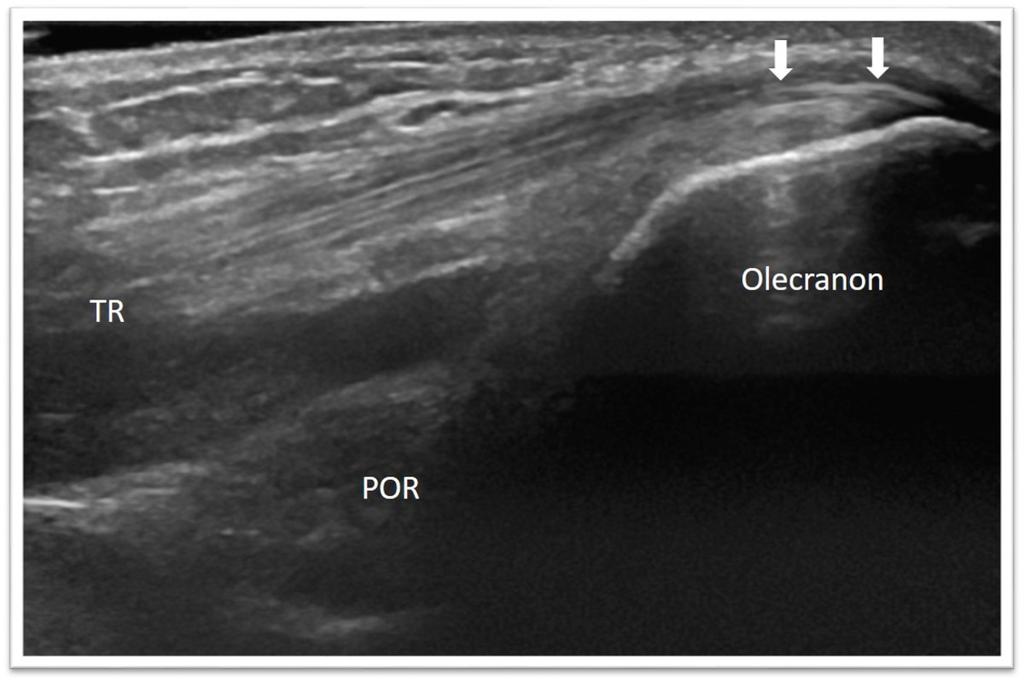 Fig. 15: Posterior elbow approach Fig.