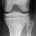 Knee Adjunct Studies MRI Bone Scan X rays CT Knee Adjunct Studies X rays Generally 4 views: 1. A-P 2. Lateral 30 degree flexion 3. Sunrise 4.