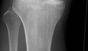 Knee Adjunct Studies X rays Alignment Joint space Fractures Bone lesions Knee Adjunct Studies X