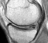 Meniscus Tears Incidence: 61 per 100,000 One of most common causes for visits to orthopedist Meniscus Tear Meniscus Tears History Giving way Buckling