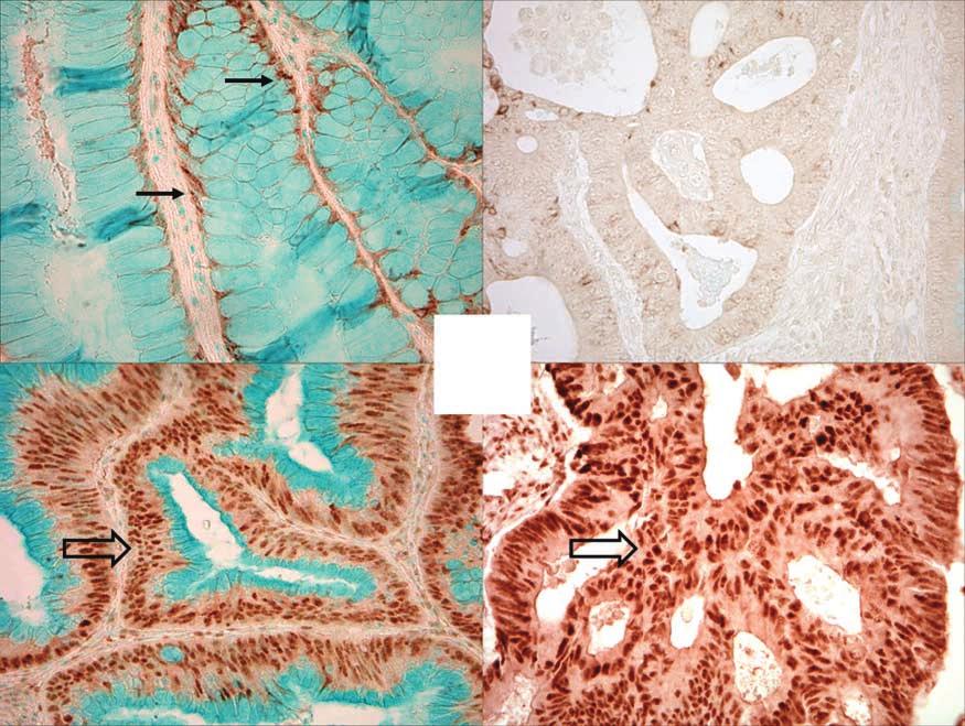 DNMT3B and CIMP in Colorectal Cancer Fig. 1. DNMT3B expression in colorectal cancer and normal mucosa. A, cytoplasmic expression of DNMT3B in normal colonic mucosa (arrows).