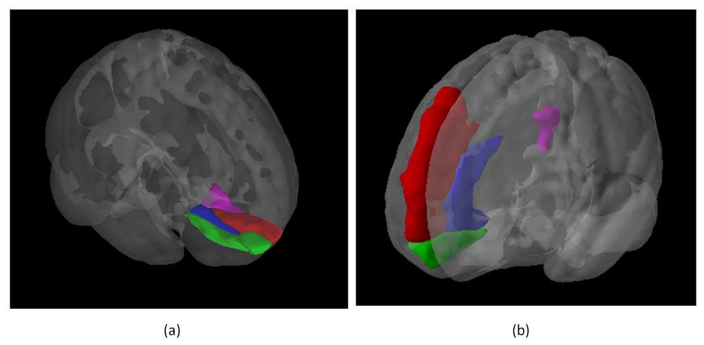 59 Figure 5.4: Two sample patterns that share the same region Right Frontal Medial Orbital (green). Post Central (green) participate in. Figure 5.5(a) shows regions Left Rolandic Operculum (red), Left Post Central (green), Left Supramarginal (blue) and Right Temporal Superior (magenta).