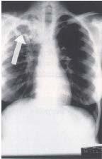 Chest x-rays are useful for diagnosing TB disease because pulmonary TB is the most common form of the disease. 4.