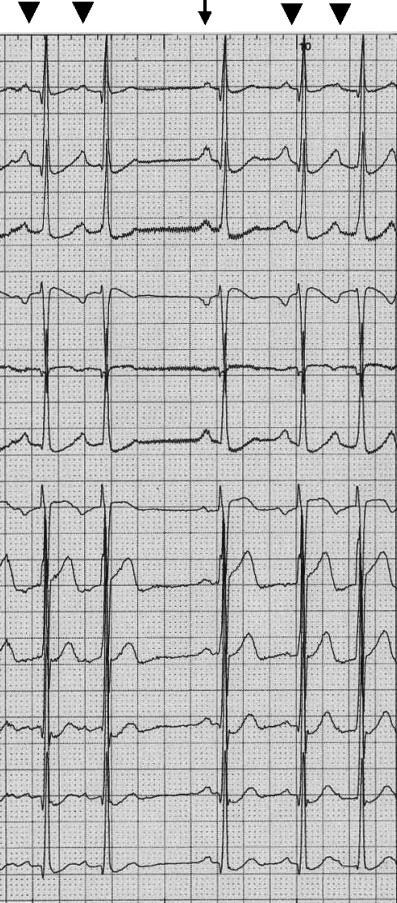 J Arrhythmia Vol 25 No 3 2009 I II III av R av L av F V 1 V 2 V 3 V 4 V 5 V 6 25 mm/s Figure 1 12-lead electorcardiogram showed continuous atrial tachycardia incessantly.