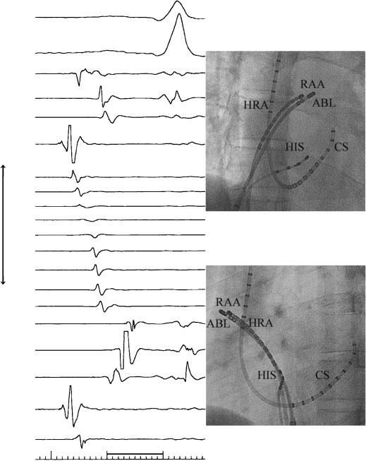 J Arrhythmia Vol 25 No 3 2009 I II RAO HRA HIS d HIS p MAP d LAO MAP p CS d CS m CS p ABL d ABL p 100 msec Figure 4 Intracardiac electrograms and fluoroscopic images where the radiofrequency current