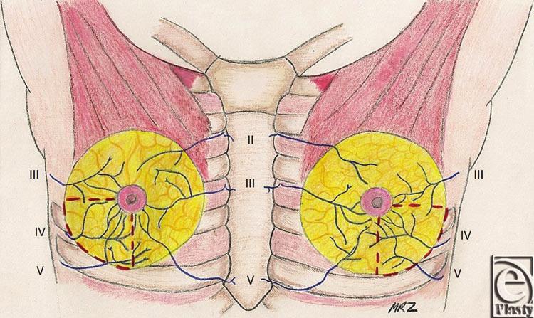 eplasty VOLUME 15 anatomical study demonstrated the innervation of the nipple to come laterally from 3 to 5 branches off of the fourth intercostal nerve.
