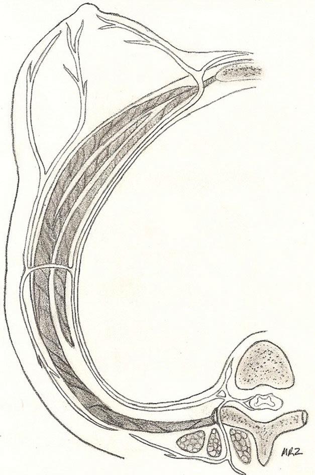 RICCIO ET AL and fifth intercostal nerves. Such technique will reliably maintain the primary innervation of the nipple and maximize patient satisfaction. Figure 2.