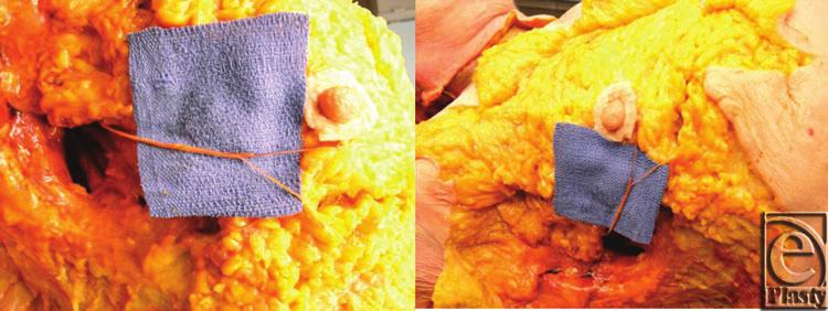 eplasty VOLUME 15 Figure 3. Photographs from cadaveric dissection, highlighting the course of the fourth intercostal nerve in the inferolateral quadrant.