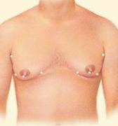 Excision: Excision techniques are recommended where glandular breast tissue or excess skin must be removed to correct