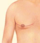 Excision also is necessary if the areola will be reduced, or the nipple repositioned to a more natural male contour.
