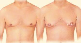 Procedural Steps: What happens during Gynaecomastia correction surgery? Plastic surgery procedure to reduce breast size, flattening and enhancing the chest contours.