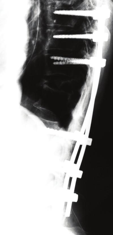 Case Reports in Orthopedics 3 Figure 3: Lateral view on plain X-ray radiography after the first surgery. (a) Figure 5: Images after the second surgery, HE staining ( 40).