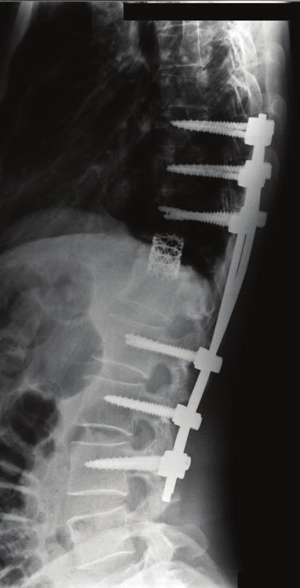 Since a defect was evident in the anterior column, no tumor cells were observed on pathological examination, and the pulmonary lesion did not progress;total en bloc spondylectomy was performed 2
