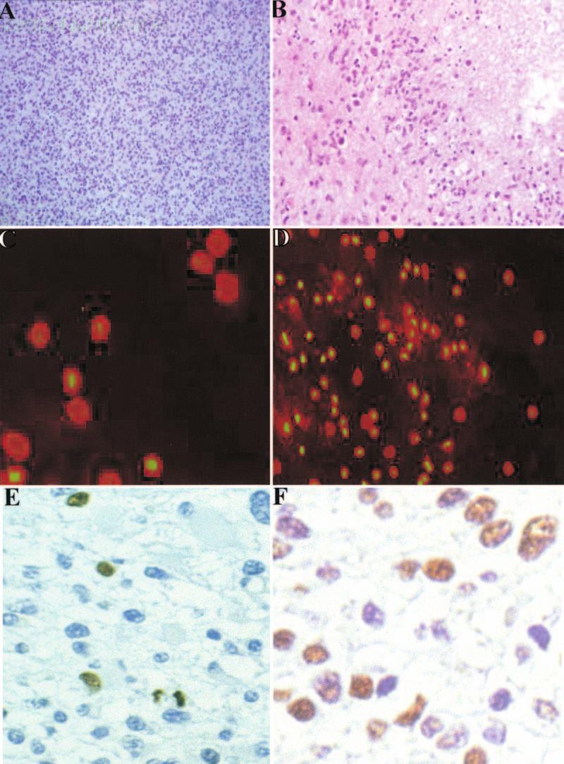 R. J. Weil, et al. FIG. 2. Photomicrographs demonstrating different methods to determine S-phase staining of malignant gliomas.