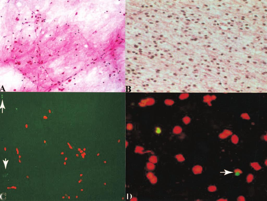 Detection of proliferating S-phase brain tumor cells FIG. 3. Photomicrographs showing the results of S-phase staining of healthy brain tissue and a low-grade astrocytoma. A: Healthy temporal lobe.