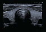 Jugular Valve Normal Thyroid Differential Tissue Harmonics (D-THI) D-THI* overcomes the limitations of conventional Tissue