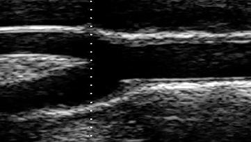 B-mode ultrasound image of the carotid artery, taken at the optimal angle of interrogation (showing the CCA, bifurcation,
