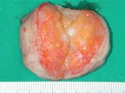 Lipoma Lipomas - benign tumors of fat, are the most common soft tissue tumor of adulthood.