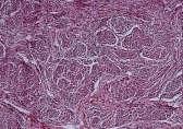 155 - Meningioma MI: tumor is composed of fusiform cells with uniform nuclei, arranged in onion-skinlike whorls.