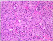 155 - Meningioma Meningiomas: composed of whorled nests of cells or spindled forming short fascicles Various histologic patterns are observed, with no prognostic significance.