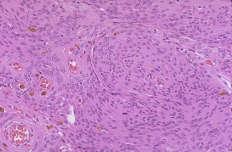 Anaplastic (malignant) meningioma is a highly aggressive tumor with the appearance of a high-grade sarcoma, but retaining some histologic evidence of meningothelial origin.