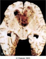 MA: poorly defined, gray, infiltrative tumor that expands and distorts the invaded brain; range in size from a few centimeters to enormous lesions that replace an entire