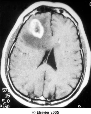 Some areas are firm and white, others are soft and yellow (the result of tissue necrosis), and yet others show regions of cystic degeneration and hemorrhage.