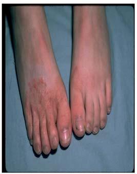 Clinical forms Tinea pedis or Athlete s