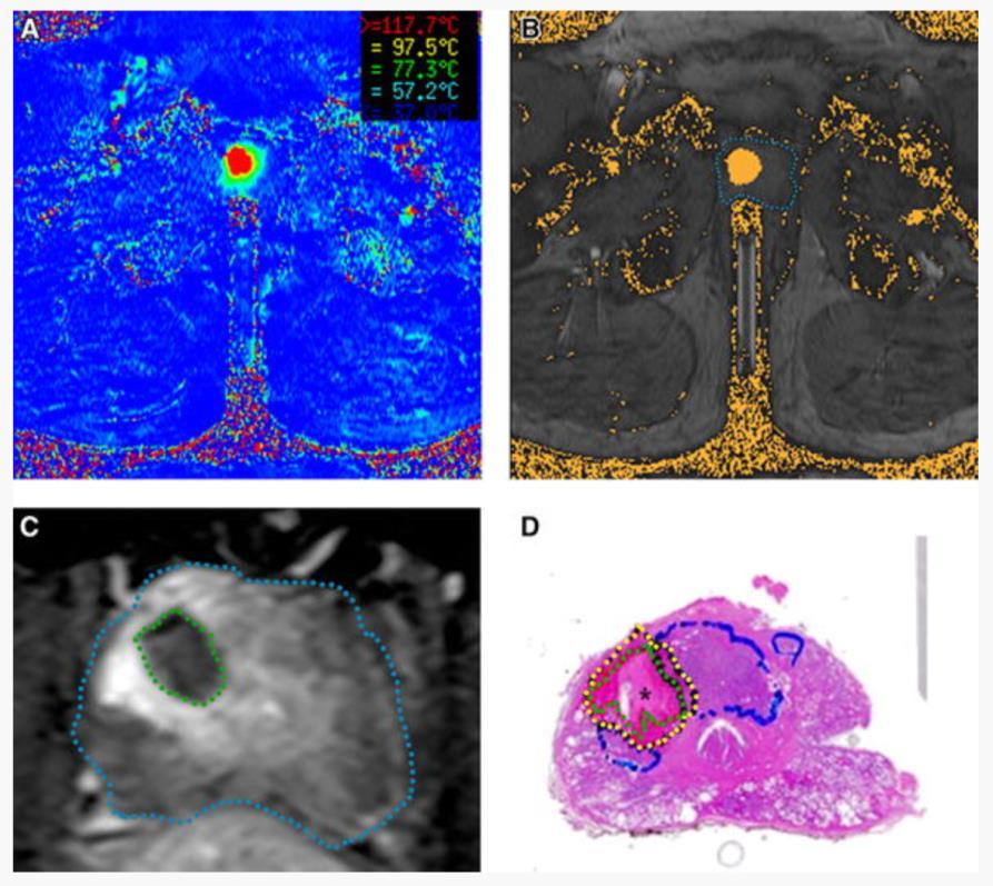 Confirming FLA ablation zone MRI-guided FLA creates ablation with no evidence of viable cells in treated