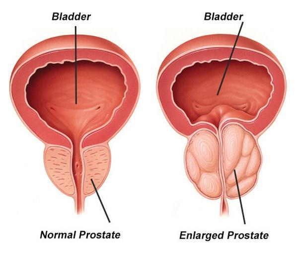 Benign prostatic hyperplasia (BPH) Affects about 50%