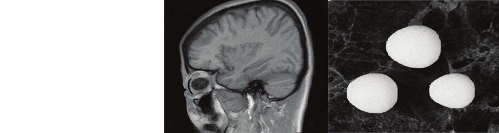MJ Kang, et al. Surgical Outcomes of the Conical Orbital Implant ing of the inferior fornix, cause further significant pain in patients who have already undergone considerable stress.