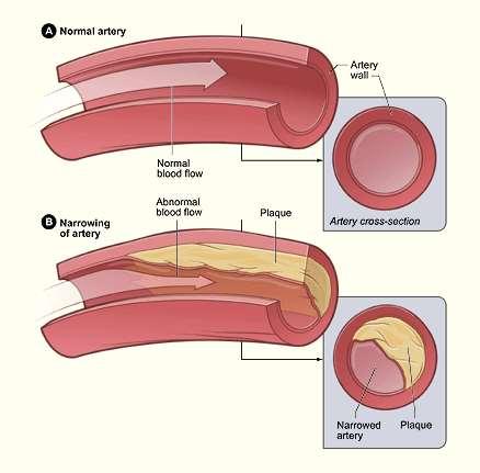 Atherosclerosis A disease in which plaque builds up inside your