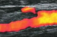 Miloševič Z et al / Cerebral hyperperfusion syndrome 295 Figure 4. Colour Doppler ultrasound of the internal carotid artery shows a visibly patent vessel. References 1.