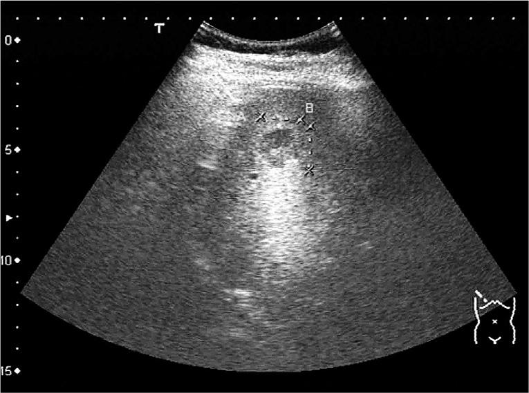 spot in early arterial phase and an avascular area