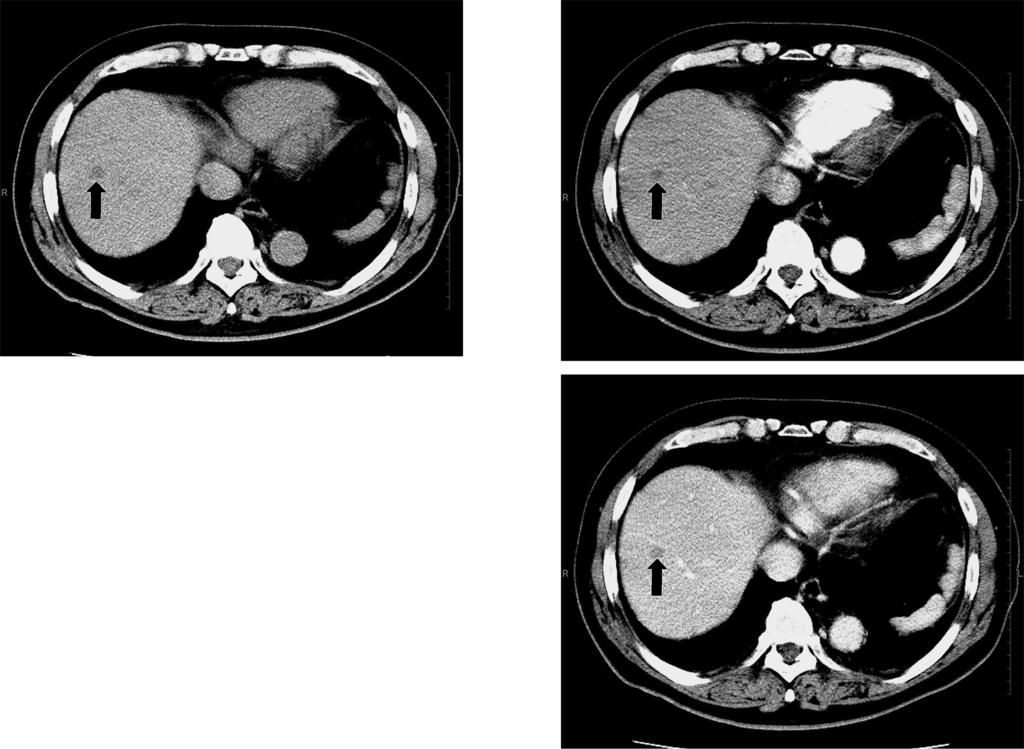 C SVR 7 Fig. 2 Abdominal CT scan showed low density area in S8 of the liver arrow, and no enhancement on arterial and portal phase. 2004 3 S8 5 mm 5 : 53 : 3 8 53 : : 75 cm 85 kg BMI 27.8 36.