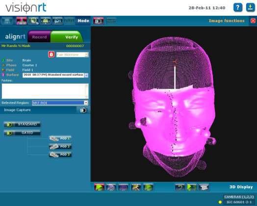Optical systems-patient surface tracking (AlignRT) VisionRT is a video-based three-dimensional (3D) surface