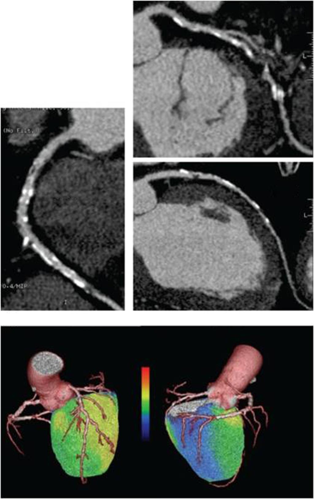 Cardiovascular Diagnosis and Therapy, Vol 7, No April 7 9 A LCX RCA LAD B Anterior view Posterior view Figure Hybrid PET/CT allows non-invasive evaluation of the coronary anatomy and functional