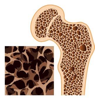 Bone health Premature menopause and/or treatment related amenorrhea increase the risk of bone thinning.
