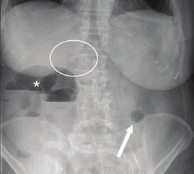 2 Case Reports in Surgery Figure 1: Plain abdominal