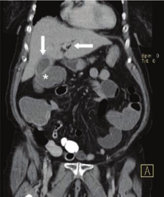 by the circle, ectopic gallstone indicated by the arrow,